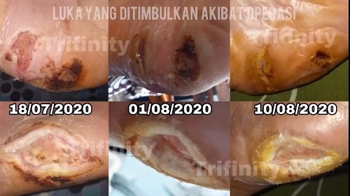 Kisah Ibu Siti berjuang menormalkan gula darah diabetes 600mg/dl secara alami dan luka pun sembuh